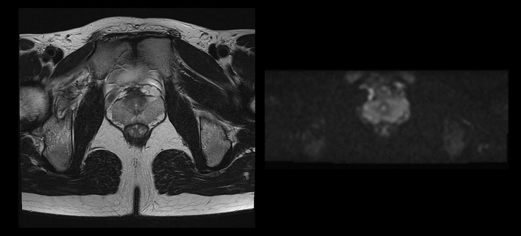 前立腺がんが再発する可能性