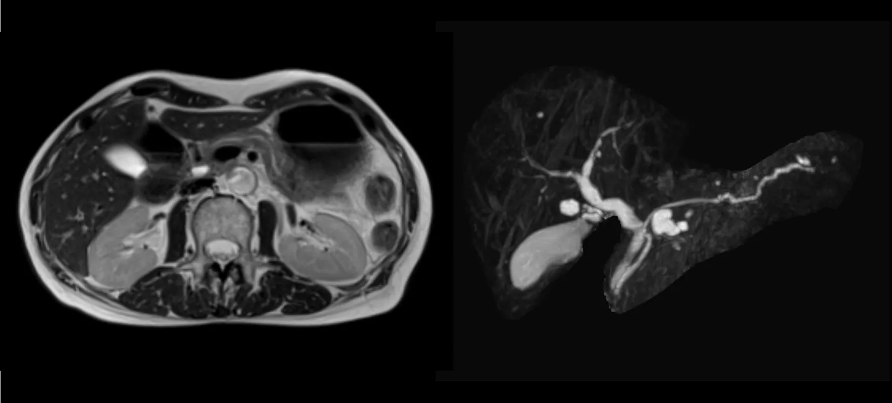 腹部のMRI