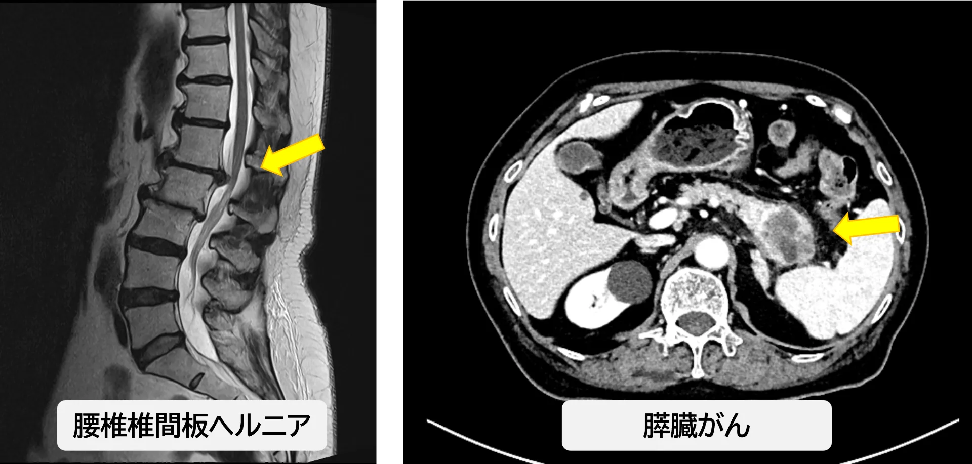 背中や腰の痛み